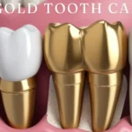 Gold Tooth Cap